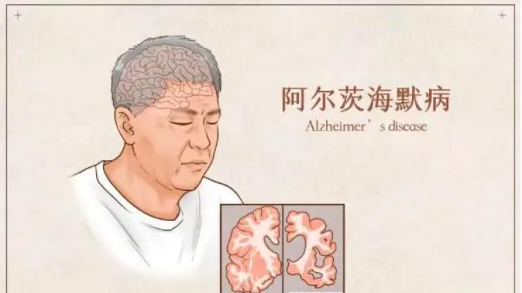 阿尔茨海默病家庭护理这样做